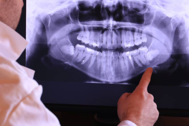 Best Emergency Tooth Extraction in Hebbronville, TX